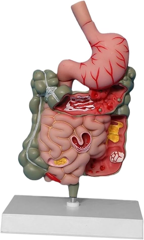 Human Stomach Anatomy Model Pathological Digestive System Model, Removerable Teaching Model for Classroom Demonstration